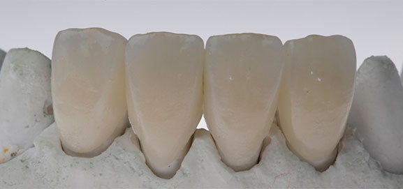 coronas cementadas realizadas en laboratorio dental unistar