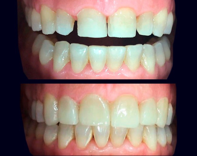 antes y después de tratamiento con Carillas Ultra de EMAX por laboratorio Unistar