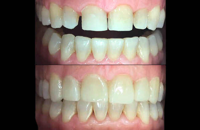 montaje antes y después de la colocación de las carillas dentales de emax
