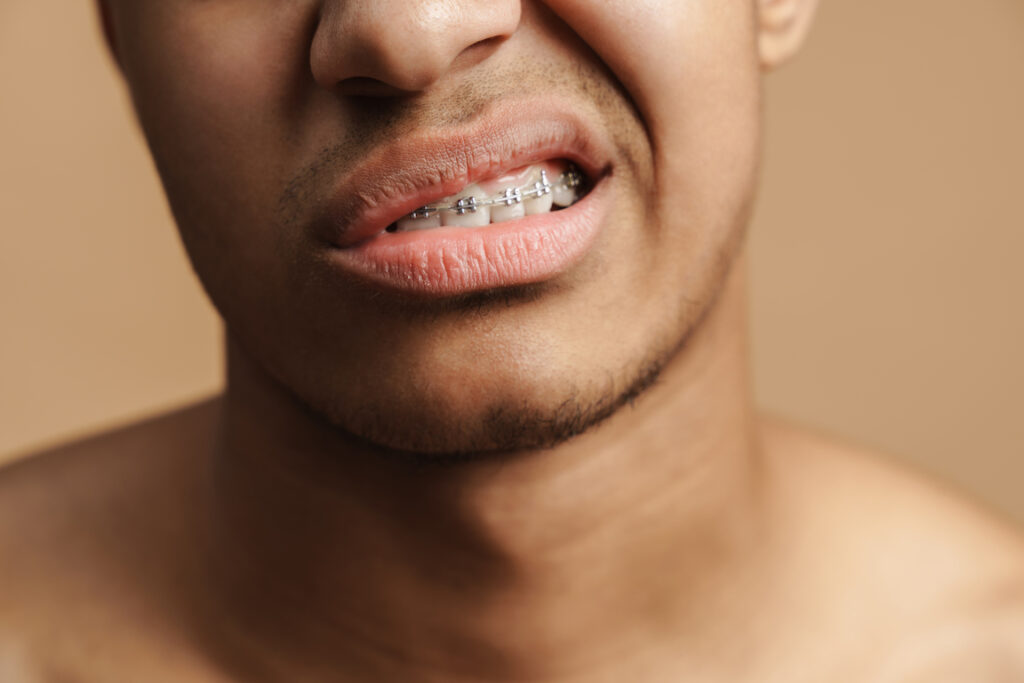 Hombre con brackets para alinear dientes