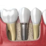 Análisis de pasividad en una estructura sobre implantes.